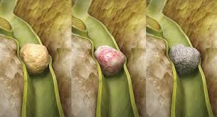 Bile Duct Stones Treatment in Electronic City